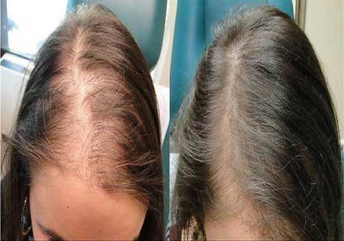 علاج ألم فروة الرأس وتساقط الشعر