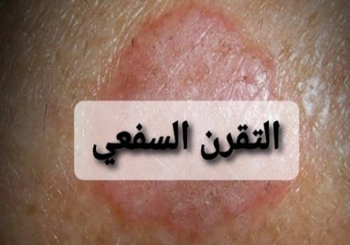 ما هو التقران السفعي
