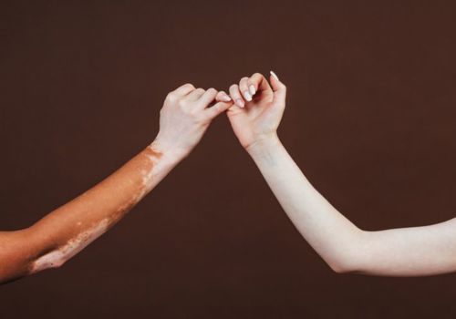 ما الفرق بين البهاق والبرص من حيث التعريف؟